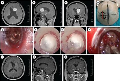 Application of endoport-assisted neuroendoscopic techniques in lateral ventricular tumor surgery